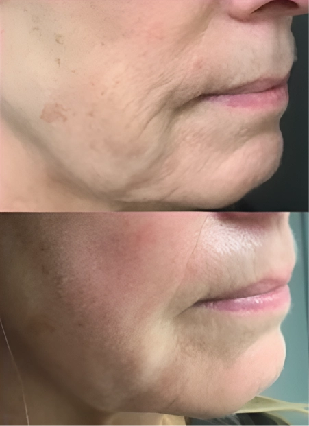 PRX Derm Perfexion® in Destin, FL Before after (1)