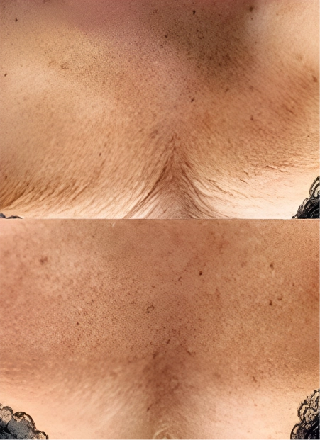 PRX Derm Perfexion® in Destin, FL Before after (2)