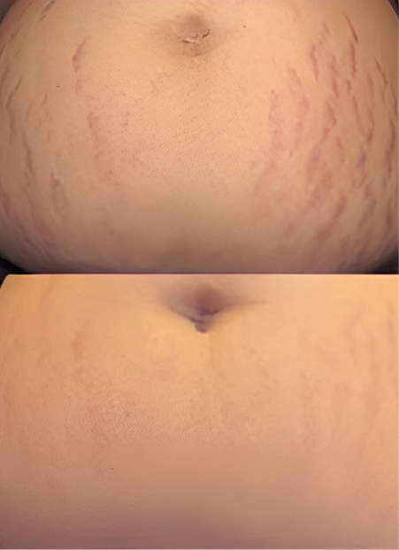 PRX Derm Perfexion® in Destin, FL Before after (3)
