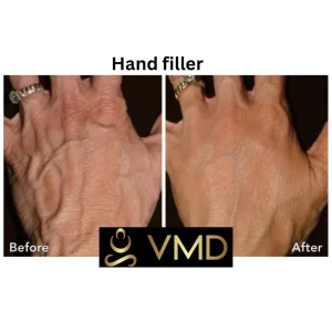 Vivana MD Dermal-filler Before After Image a In Destin, FL