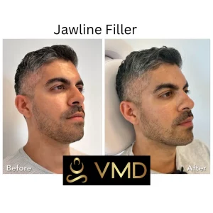 Vivana MD Dermal-filler Before After Image b In Destin, FL
