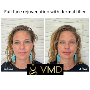 Vivana MD Dermal-filler Before After Image d In Destin, FL