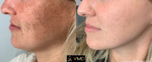 Vivana MD IPL Photofacial Before After Image one In Destin, FL