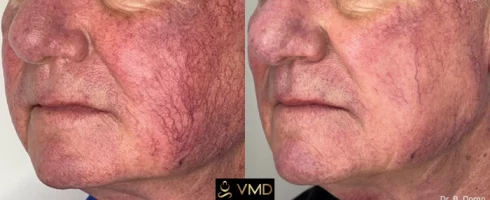 Vivana MD IPL Photofacial Before After Image two In Destin, FL