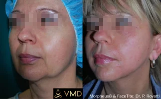 Vivana MD Morpheus Before After Image two In Destin, FL
