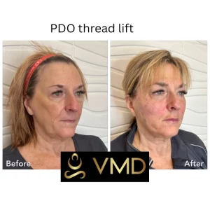 Vivana MD PDO Threads Before After Image Five In Destin, FL