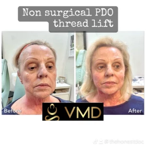 Vivana MD PDO Threads Before After Image Four In Destin, FL