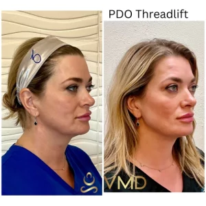 Vivana MD PDO Threads Before After Image One In Destin, FL