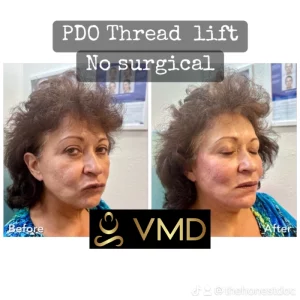 Vivana MD PDO Threads Before After Image Three In Destin, FL