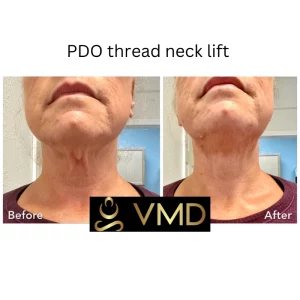 Vivana MD PDO Threads Before After Image Two In Destin, FL