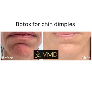 Vivana MD botox Before After Image a In Destin, FL