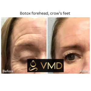 Vivana MD botox Before After Image d In Destin, FL