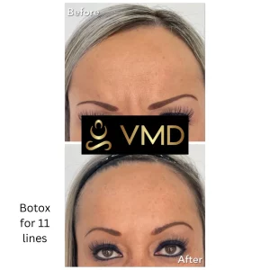 Vivana MD botox Before After Image f In Destin, FL