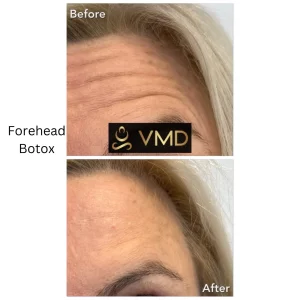 Vivana MD botox Before After Image h In Destin, FL