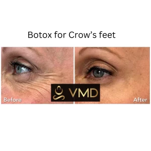 Vivana MD botox Before After Image i In Destin, FL
