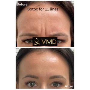 Vivana MD botox Before After Image k In Destin, FL