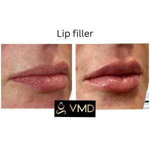 Vivana MD -lip-filler Before After Image a In Destin, FL