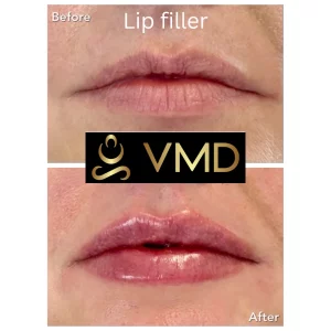 Vivana MD -lip-filler Before After Image b In Destin, FL