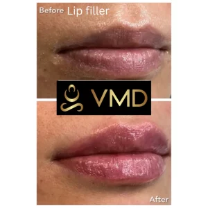 Vivana MD -lip-filler Before After Image c In Destin, FL