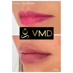 Vivana MD -lip-filler Before After Image d In Destin, FL