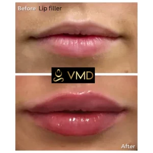 Vivana MD -lip-filler Before After Image e In Destin, FL
