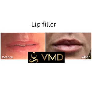 Vivana MD -lip-filler Before After Image f In Destin, FL