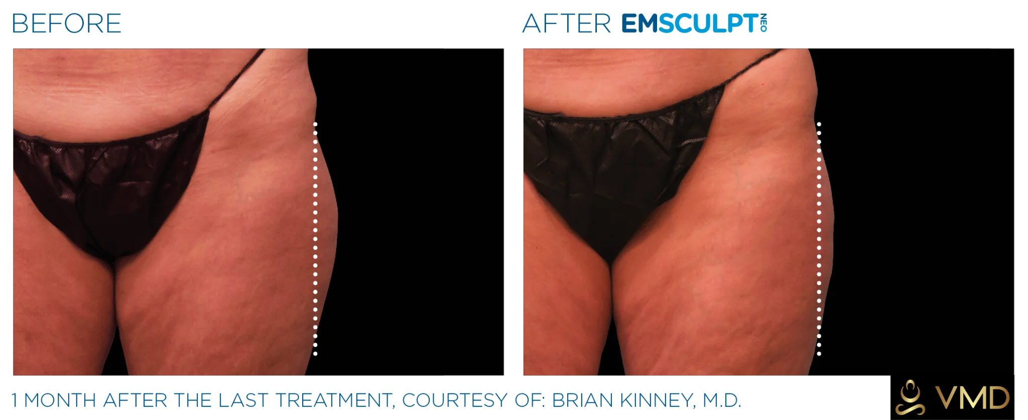 Vivana-MD-Emsculpts-Neo-gallery-e-in-Destin-FL