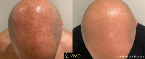 Vivana MD IPL Photofacial Before After Image five In Destin, FL