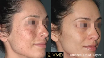 Vivana MD IPL Photofacial Before After Image four In Destin, FL