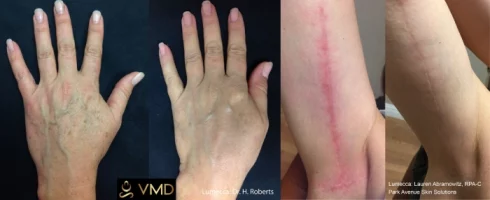 Vivana MD IPL Photofacial Before After Image three In Destin, FL